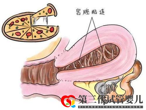 子宫粘连可以做试管婴儿吗?成功率高不高?(图2) 子宫粘连可以做试管婴儿吗?成功率高不高?(图2)