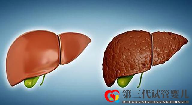 老年肝硬化的原因有哪些?医生:多数可以避免(图2) 老年肝硬化的原因有哪些?医生:多数可以避免(图2)
