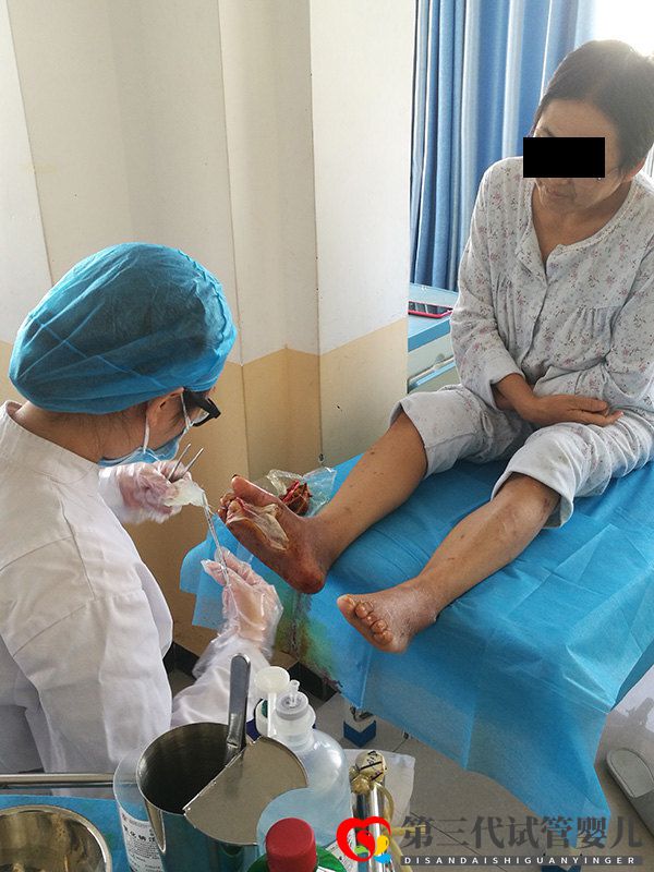 糖尿病并发症糖尿病足到底有多可怕,可以避免截肢吗?(图2) 糖尿病并发症糖尿病足到底有多可怕,可以避免截肢吗?(图2)