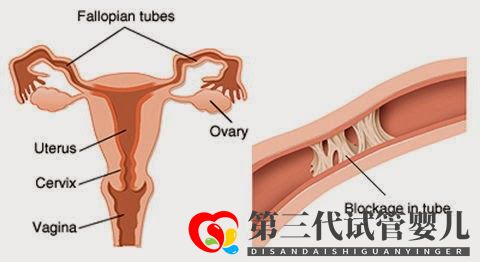 输卵管堵塞,怀孕到底有多难(图3) 输卵管堵塞,怀孕到底有多难(图3)