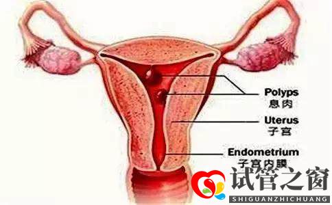 试管之窗:子宫内膜有息肉要切除才能做试管婴儿吗(图2) 试管之窗:子宫内膜有息肉要切除才能做试管婴儿吗(图2)