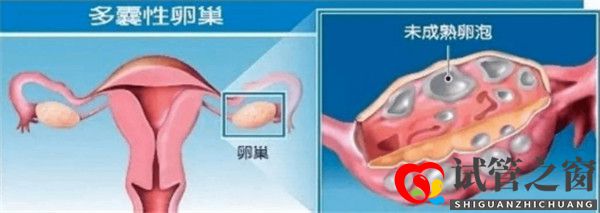多囊卵巢综合征对试管婴儿成功率有哪些影响如何及时调理(图1) 多囊卵巢综合征对试管婴儿成功率有哪些影响如何及时调理(图1)