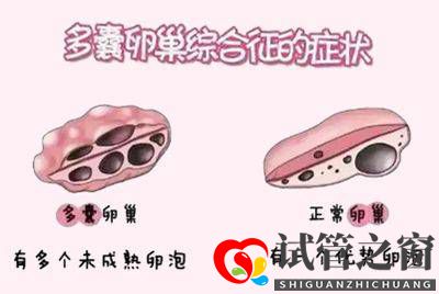 多囊做试管婴儿要注意什么(图2) 多囊做试管婴儿要注意什么(图2)