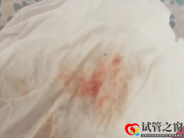 试管取卵对女性卵巢的危害大,术后出血千万别大意(图2) 取卵后出现少量出血为正常现象