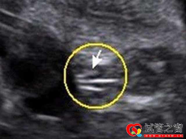 16周最明显的女宝b超图分享,看这三条线一眼便知!(图2) 女宝b超图三条线