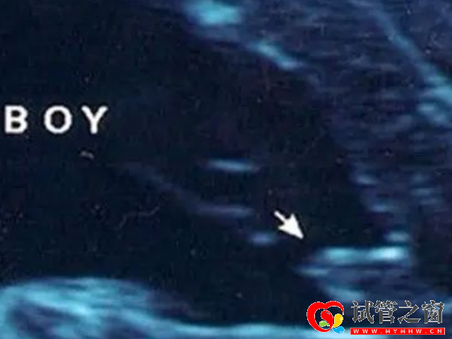 16周最明显的女宝b超图分享,看这三条线一眼便知!(图3) 男孩b超图