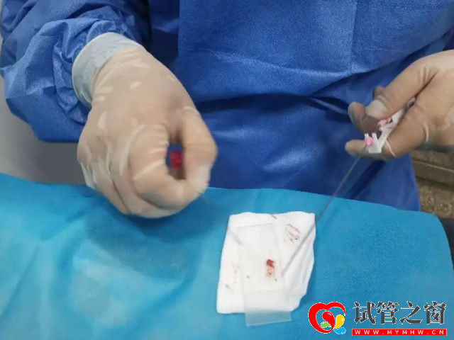 睾丸穿刺手术费用清单,术前检查+手术费不超过这个数(图2) 睾丸穿刺是经过皮肤对睾丸进行穿刺