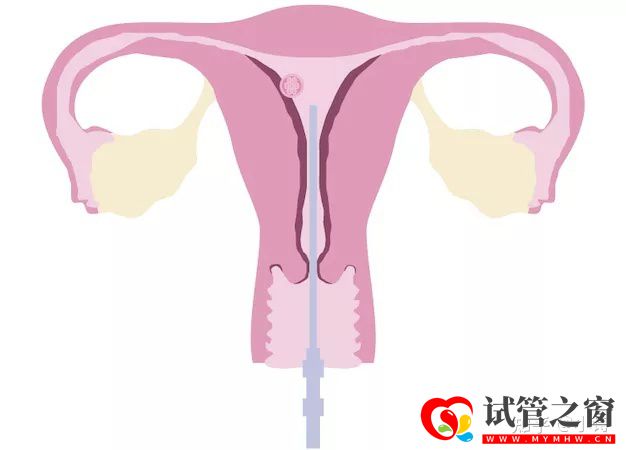 三代试管的真相,80%的人都不知道!学姐说(图5) 三代试管的真相,80%的人都不知道!学姐说(图5)