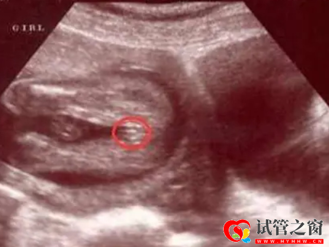 四维彩超男女参照图对比,一看有这个特征是男宝几率最大(图2) 四维彩超怀女孩的特征