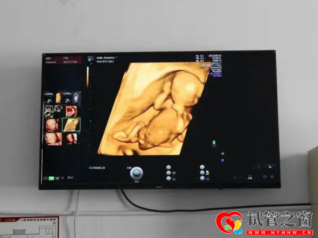 四维b超男孩女孩脸型参照图,面相有清秀多半是男孩(图2) 四维彩超胎儿面相清秀是男孩