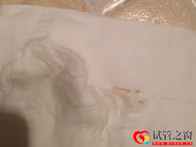 排卵期白带拉丝状图片分享,精准找排卵日还得要靠它(图1) 排卵期女性白带量会增加