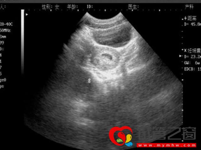 试管怀孕后容易出现胎盘低置吗?(图1) 试管怀孕易出现胎盘低置