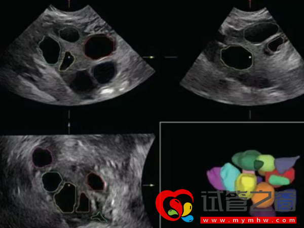 B超查空卵泡准确率并不高!如何能查出方法有三种(图1) B超不能查出空卵泡