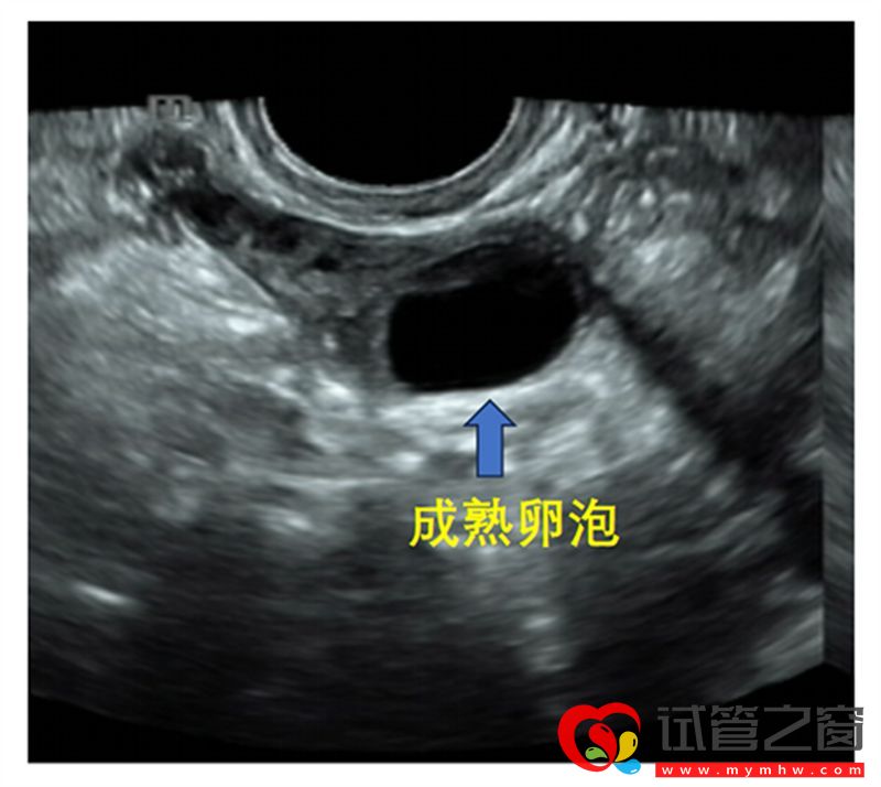 详解B超监测排卵的那些事,助你交好“孕”(图1) 详解B超监测排卵的那些事,助你交好“孕”(图1)
