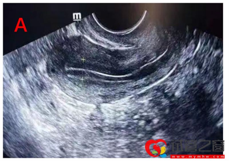 详解B超监测排卵的那些事,助你交好“孕”(图2) 详解B超监测排卵的那些事,助你交好“孕”(图2)