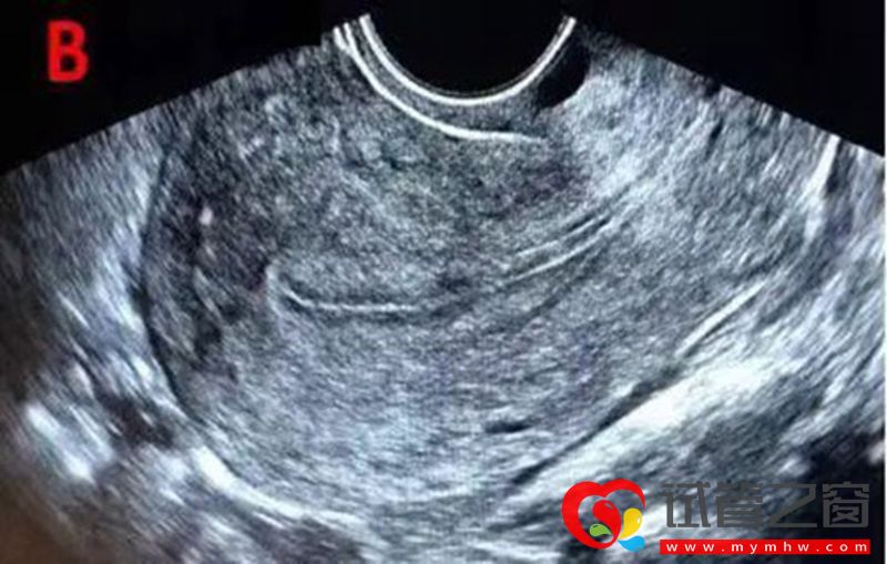 详解B超监测排卵的那些事,助你交好“孕”(图3) 详解B超监测排卵的那些事,助你交好“孕”(图3)