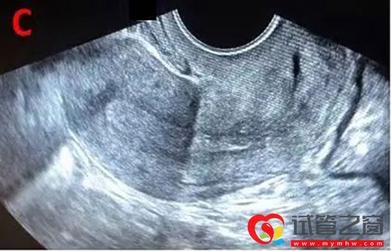 详解B超监测排卵的那些事,助你交好“孕”(图4) 详解B超监测排卵的那些事,助你交好“孕”(图4)