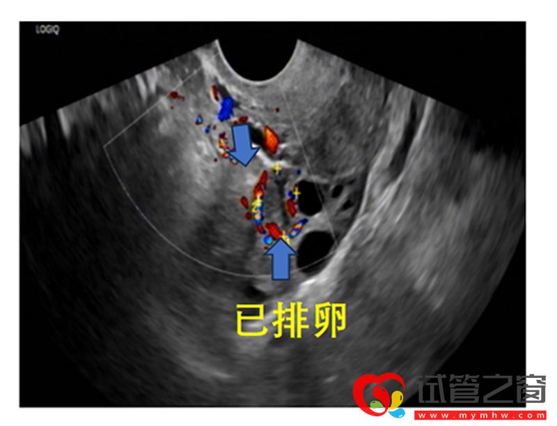 详解B超监测排卵的那些事,助你交好“孕”(图5) 详解B超监测排卵的那些事,助你交好“孕”(图5)