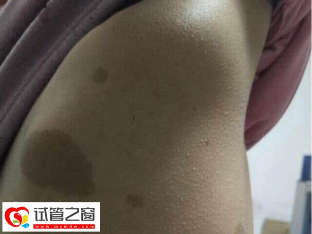 神经纤维瘤可不可以做试管婴儿(图1) 神经纤维瘤可能会影响卵子质量