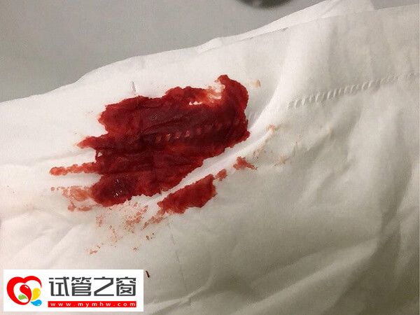 移植两个鲜胚可能会有出血现象,或与内膜受刺激有关(图1) 鲜胚移植后出血是不是胚胎着床失败了