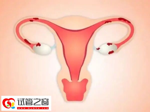 巧克力囊肿对试管婴儿的影响有哪些(图1) 巧克力囊肿会影响宫腔环境