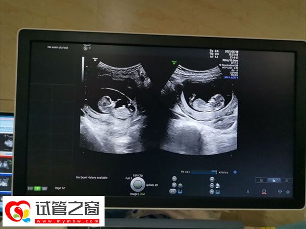 移植两枚鲜胚双胞胎几率大不大(图2) 试管婴儿可以生育双胞胎