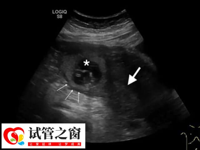 试管移植在子宫什么位置好(图1) 胚胎一般移植在子宫的中部