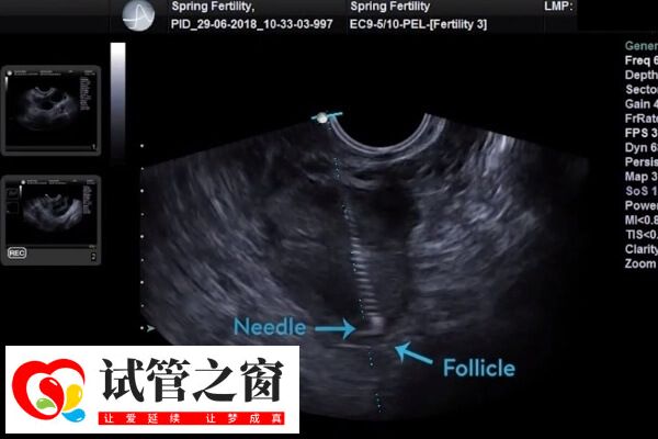 取卵后腹水怎么处理(图1) 取卵后腹水要注意及时就医