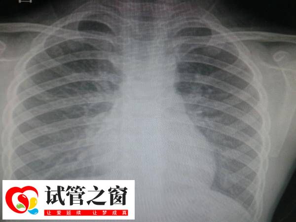试管前做胸片是查什么(图2) 做试管拍胸片是常规体检项目之一