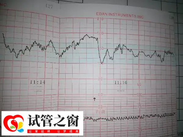 试管胚胎移植做二超能不能转产科(图2) 二超的目的是检查胎儿胎心率
