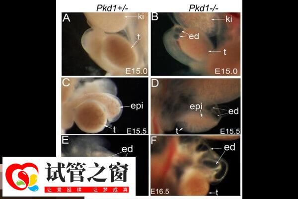 pkd1基因缺失可以生育!做好试管婴儿筛查有助优生优育(图1) PKD1基因又叫多囊肾相关基因