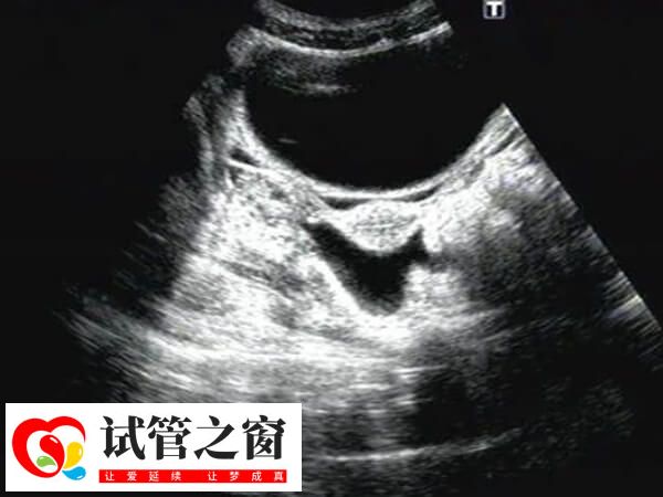 试管取卵后盆腔积液有什么症状(图1) 盆腔积液是女性生殖系统的常见症状表现