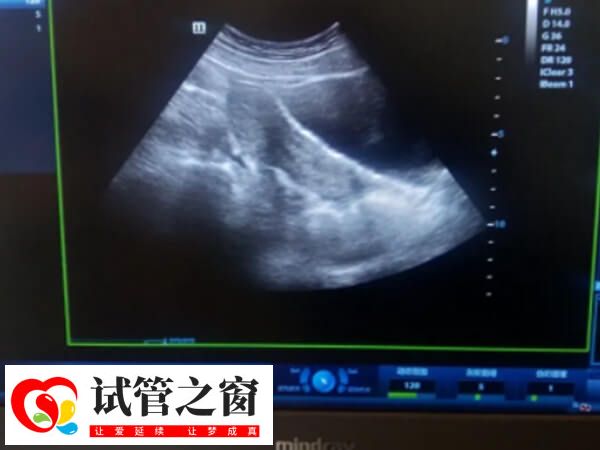 哪些情况下会取消鲜胚移植