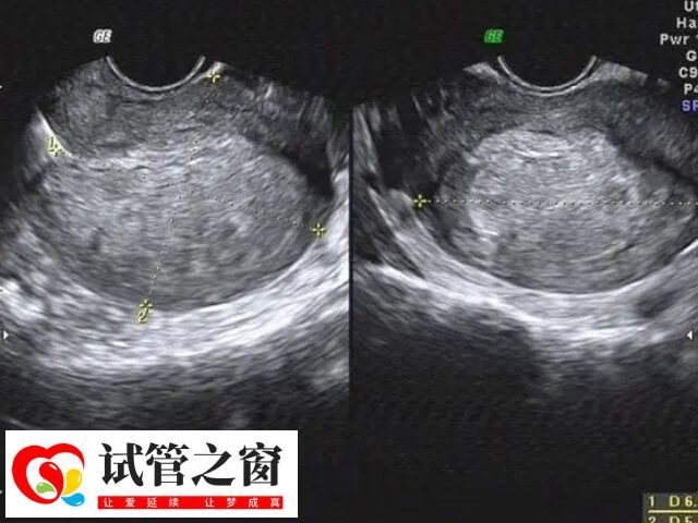 输卵管积液会不会影响试管移植