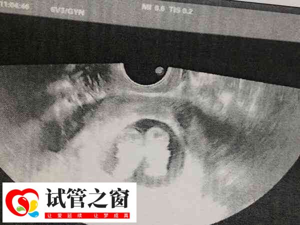 男性肺结核可不可以做试管(图1) 肺结核可能影响胚胎移植