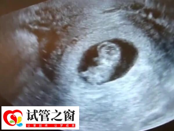 试管一超二超三超是否都是阴超(图1) 试管一超主要是看孕囊着床位置