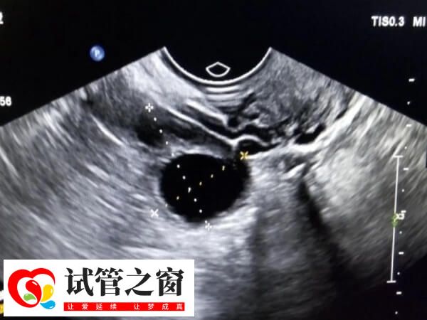 湖南中信湘雅第三代试管费用多少(图2) 促排卵期间将持续进行卵泡监测
