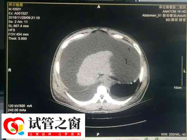 哪8种女人容易生龙凤胎(图3) 试管婴儿是一种体外受精技术