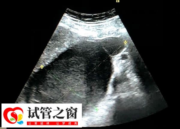 哪8大特征暗示试管失败了(图3) 试管婴儿移植后可能会感到腹部疼痛和不适