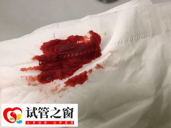 哪8大特征暗示试管失败了(图1) 做试管受孕失败后会有出血的情况