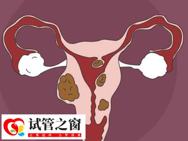 促排期间打针和吃药会让子宫肌瘤持续长大吗?(图2) 子宫肌瘤在促排期间注意密切监测