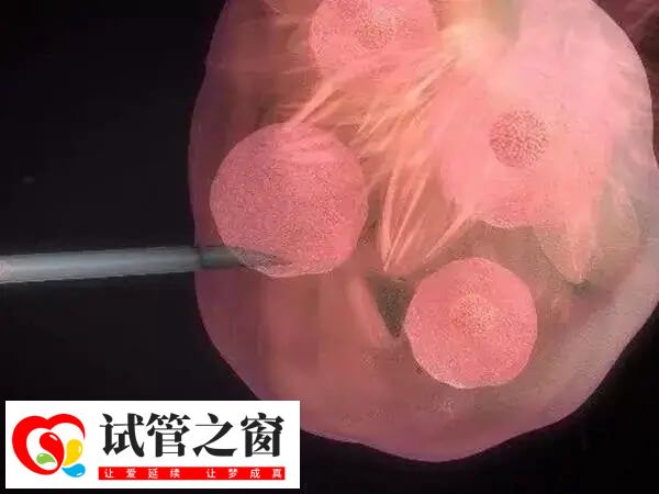 取卵手术对女性的伤害有多大(图1) 取卵前促排卵使用过多会增加患癌风险