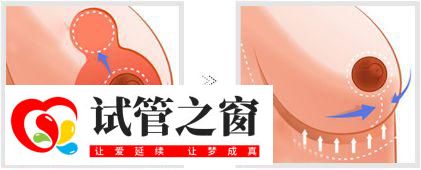 巨乳缩小术有哪些优势可以解决哪些问题(图2) 巨乳缩小术有哪些优势可以解决哪些问题(图2)