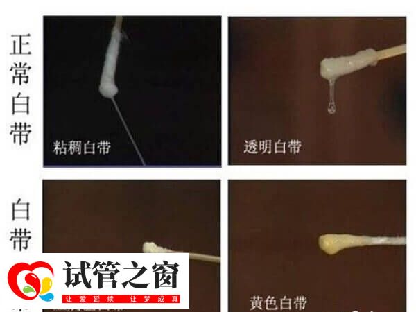 受精卵在子宫着床成功后白带会有哪些症状?(图1) 着床成功正常白带图片