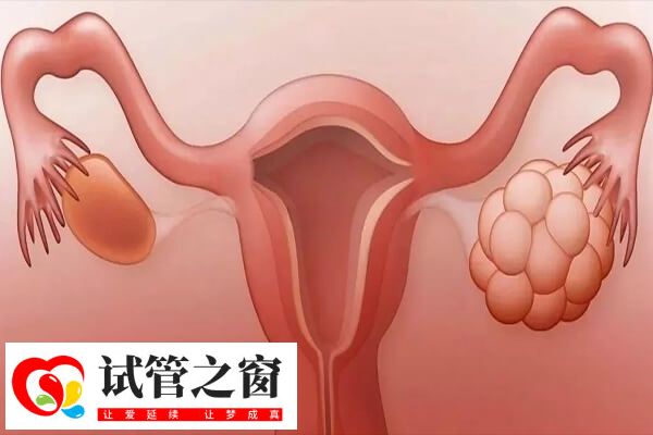 多囊反复的原因是什么(图1) 缺乏运动是多囊反复原因之一