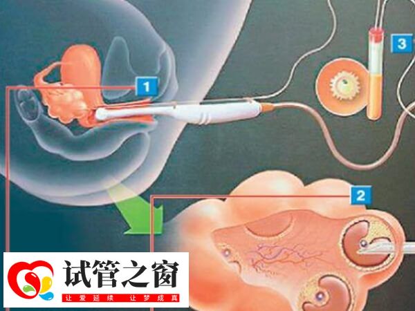 双腔取卵是不是比单腔质量差(图3) 双腔取卵和单腔取卵各有特点