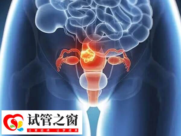 注射贺美奇有哪些副作用(图1) 不当使用贺美奇会导致卵巢过度刺激