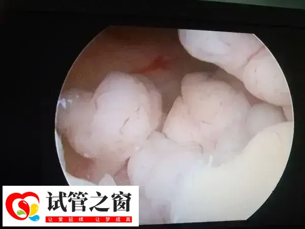 宫腔镜检查后多久能做试管婴儿(图1) 宫腔镜在临床上已经被广泛使用
