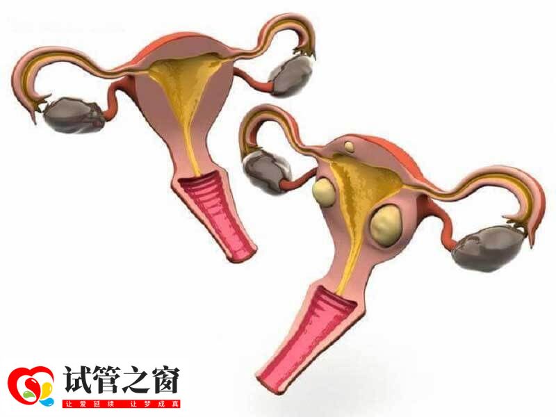 卵巢囊肿能不能做试管婴儿(图1) 病理性卵巢囊肿不建议做试管婴儿