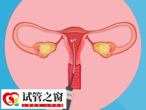 患盆腔结核能不能做试管婴儿(图1) 盆腔结核能否做试管得看治疗效果